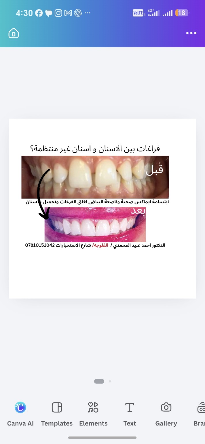 تجميل الابتسامة بالإيماكس — قبل العلاج